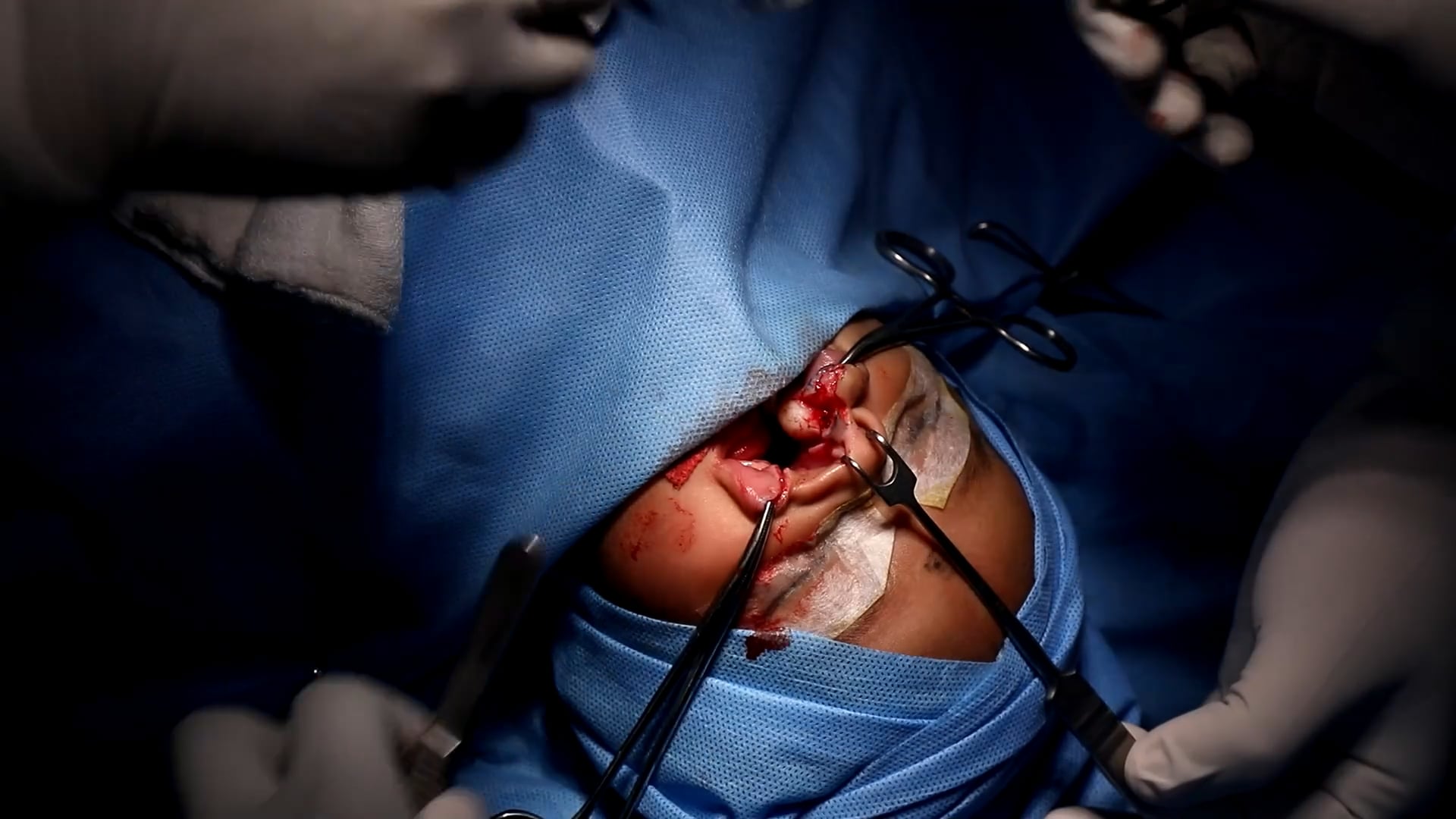 Cleft lip surgery for a cute  baby